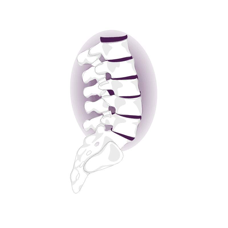 metastasi vertebrale
