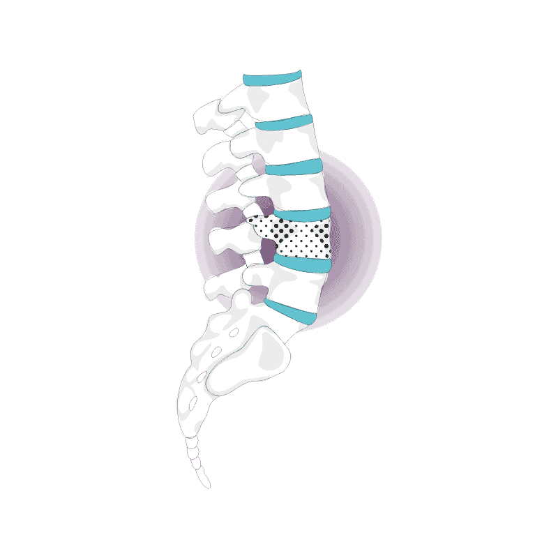 osteoporosi vertebrale