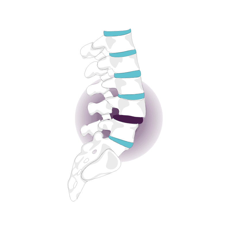 spondilolistesi