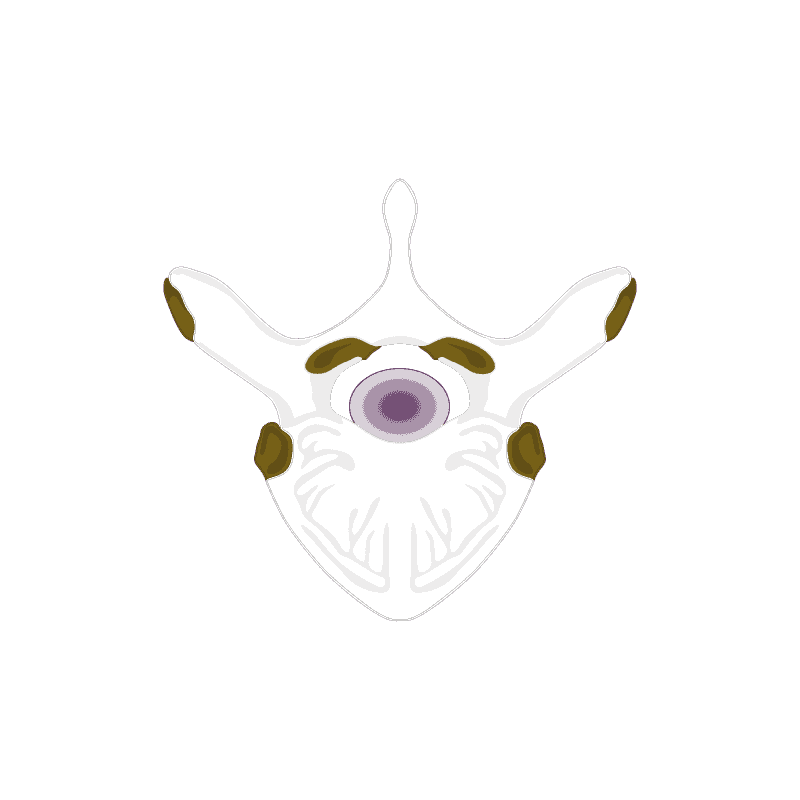 stenosi vertebra